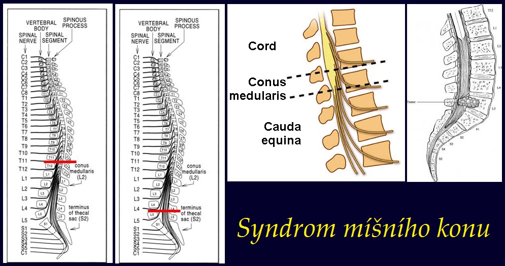 syndrom misniho konu syndrom leze conus medullaris priznaky projevy symptomy