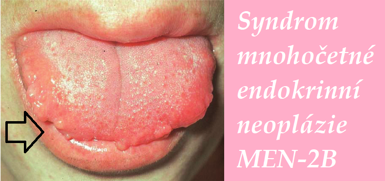 syndrom mnohocetne endokrinni neoplazie men 2b priznaky projevy symptomy