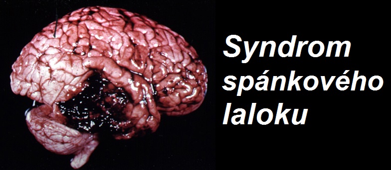 syndrom-spankoveho-laloku-priznaky-projevy-symptomy