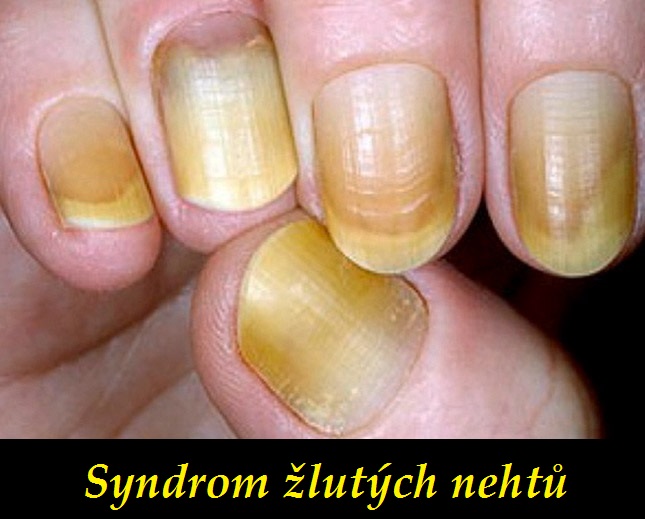 syndrom zlutych nehtu priznaky projevy symptomy