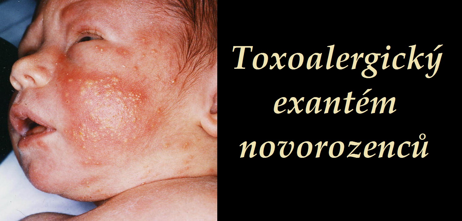 toxoalergicky exantem novorozencu erythema toxicum neonatorum priznaky projevy symptomy pricina lecba