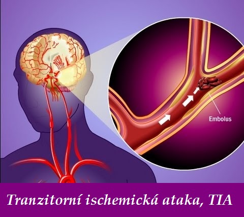 tranzitorni transitorni ischemicka ataka TIA priznaky projevy symptomy copy