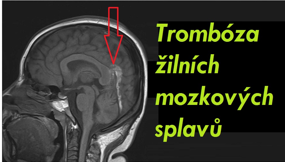 tromboza-mozkovych-zilnich-splavu-priznaky-projevy-symptomy
