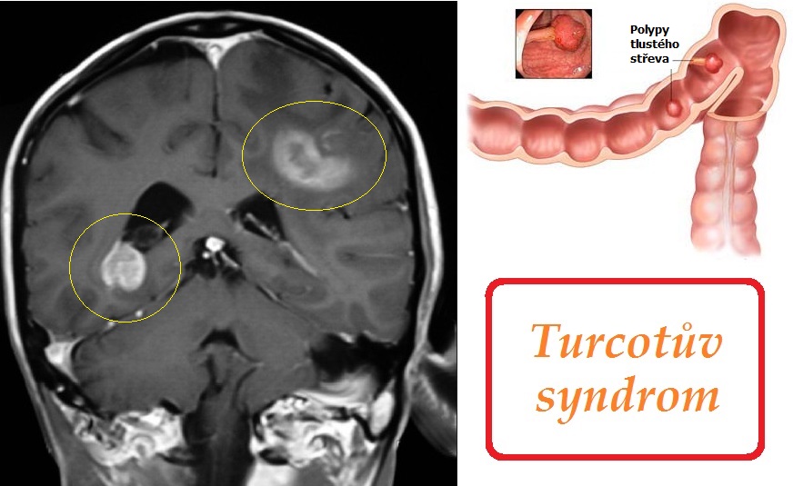 turcotuv syndrom priznaky projevy symptomy