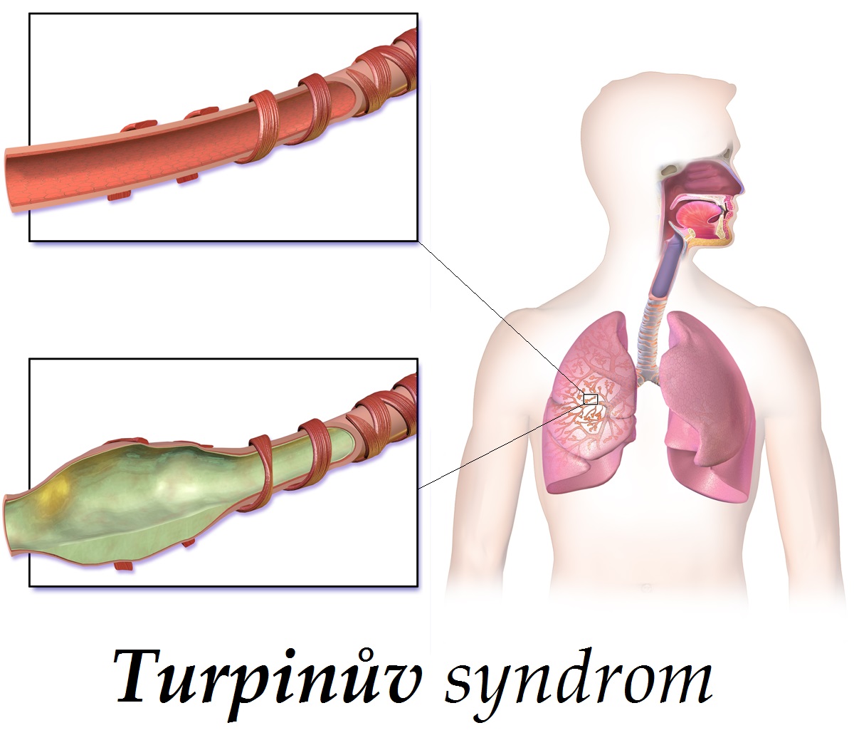 turpinuv syndrom priznaky projevy symptomy