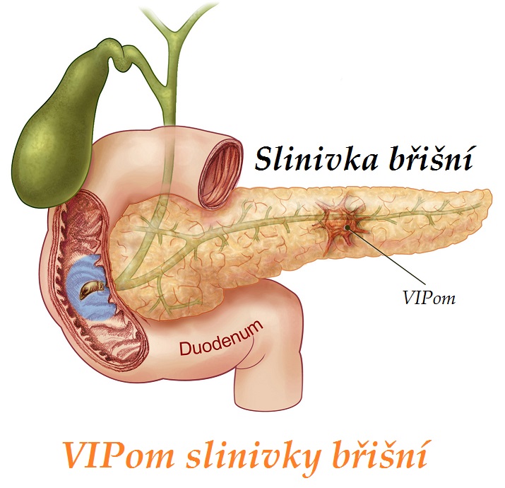 vipom nador produkujici vazoaktivni intestinalni peptid priznaky projevy symptomy