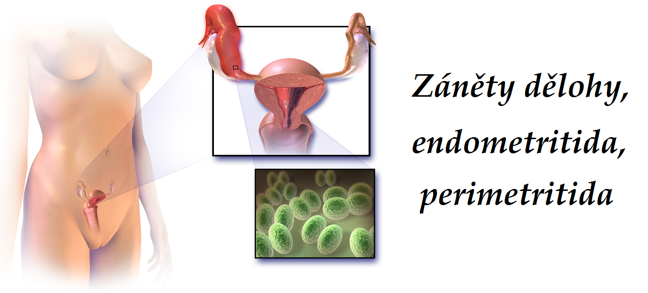 zanet-delohy-endometritida-perimetritida-priznaky-projevy-symptomy