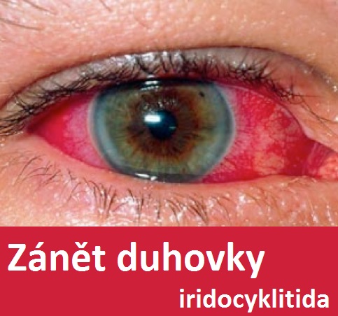 zanet-duhovky-iridocyklitida-iritis-priznaky-projevy-symptomy