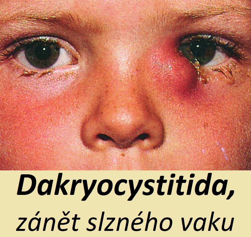 zánět slzného vaku dakryocystitida příznaky projevy symptomy příčina léčba