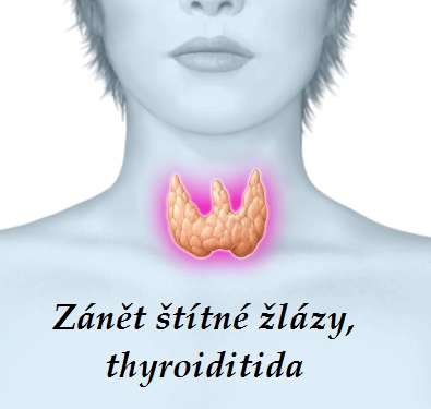 zanet-stitne-zlazy-stitnice-thyroiditida-priznaky-projevy-symptomy