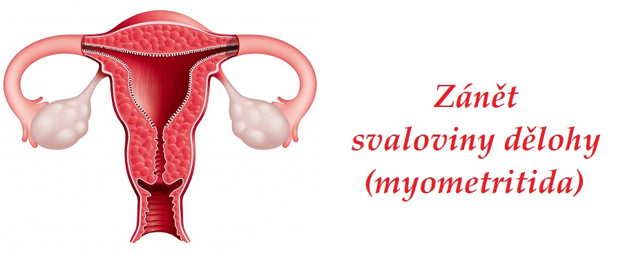 zanet svaloviny delohy myometritida myometritis priznaky projevy symptomy