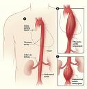 aneurysma_aorty_srdecnice_priznaky_projevy_symptomy.jpg