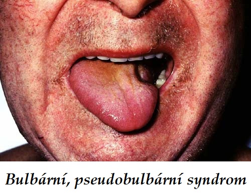 bulbarni-syndrom-priznaky-projevy-symptomy