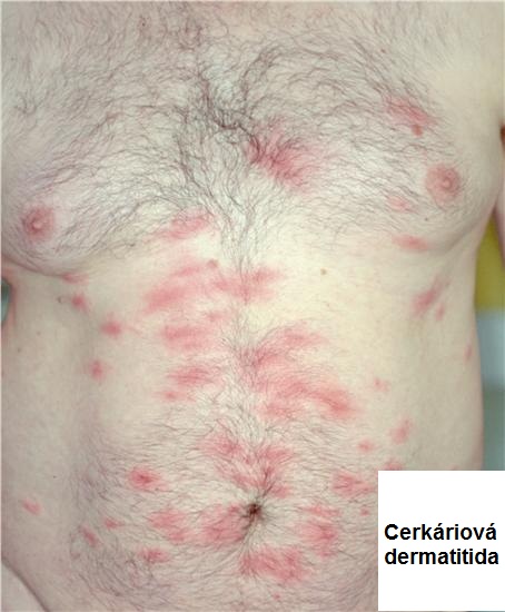 cerkarialni-cerkariova-dermatitida-priznaky-projevy-symptomy-fotografie-obrazek