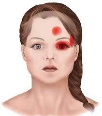 cluster-headache-cyklicka-cephalea-histaminova-bolest-hlavy-priznaky-projevy-symptomy