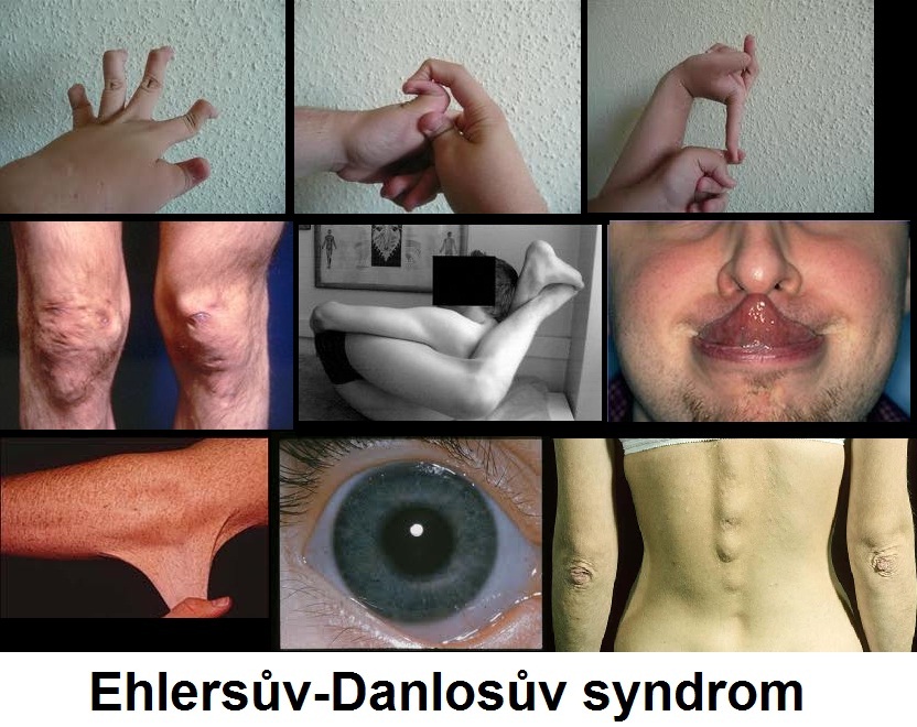 ehlersuv-danlosuv-syndrom-obrazek-fotografie-kuze-klouby-oci
