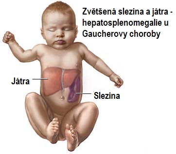 gaucherova-choroba-priznaky-projevy-symptomy-2