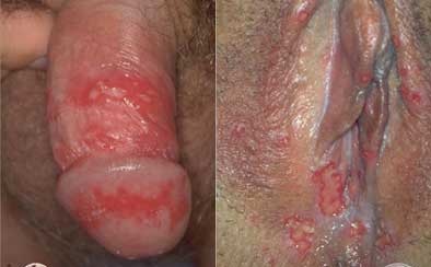 herpes-simplex-genitalis-opar-priznaky-projevy-symptomy