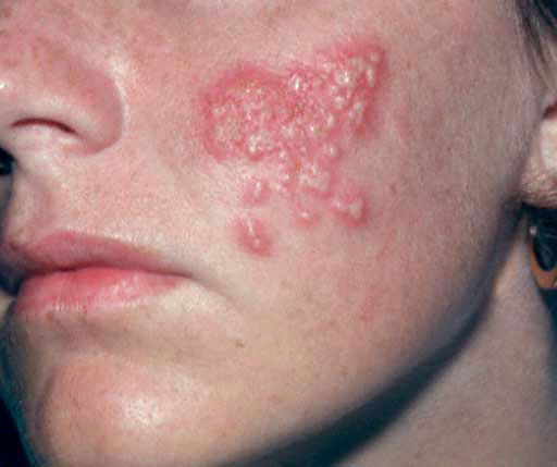 herpes-simplex-infekce-opar-priznaky-projevy-symptomy-fotografie-obrazek