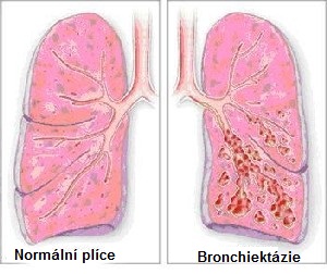 jak-se-projevuje-bronchiektazie-priznaky-projevy-symptomy-obrazek-fotografie