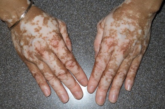 jak-se-projevuje-vitiligo-priznaky-projevy-symptomy-1