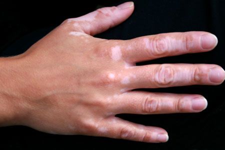 jak-se-projevuje-vitiligo-priznaky-projevy-symptomy-3