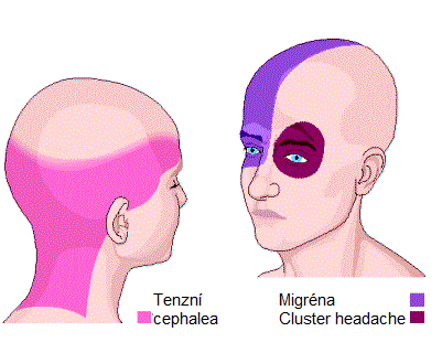 migrena-cluster-headache-tenzni-bolesti-hlavy-priznaky-projevy-symptomy