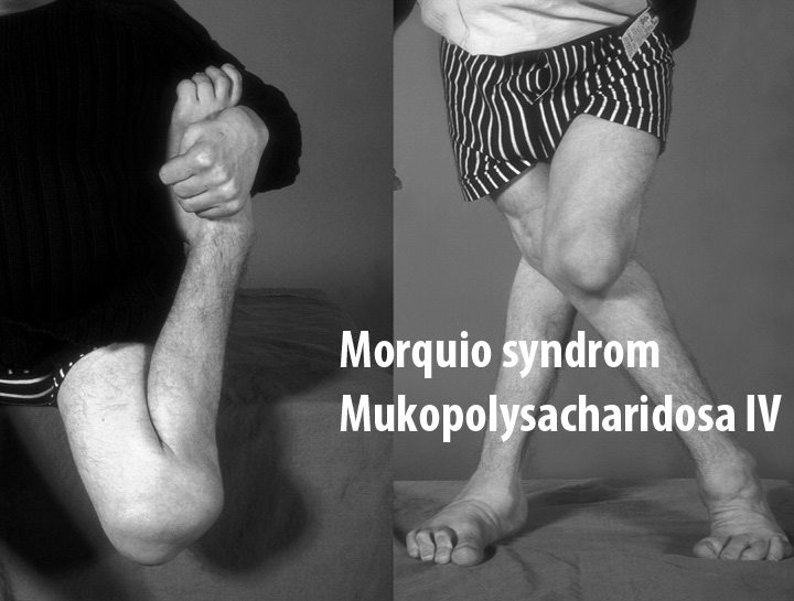 morquio-syndrom-mukopolysacharidosa-iv-priznaky-projevy-symptomy-77