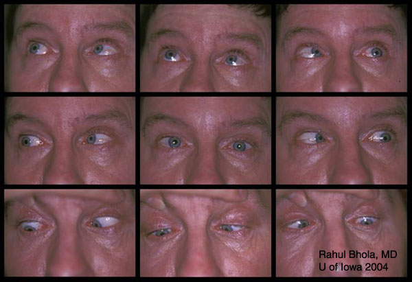 parinauduv-syndrom-oftalmoplegie-priznaky-projevy-symptomy-obrazek-fotografie