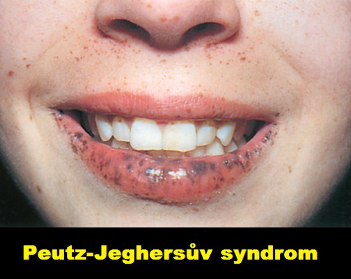peutzuv-jeghersuv-syndrom-PJS-priznaky-projevy-symptomy