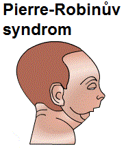 pierre-robinuv-syndrom-sekvence-priznaky-projevy-symptomy-9