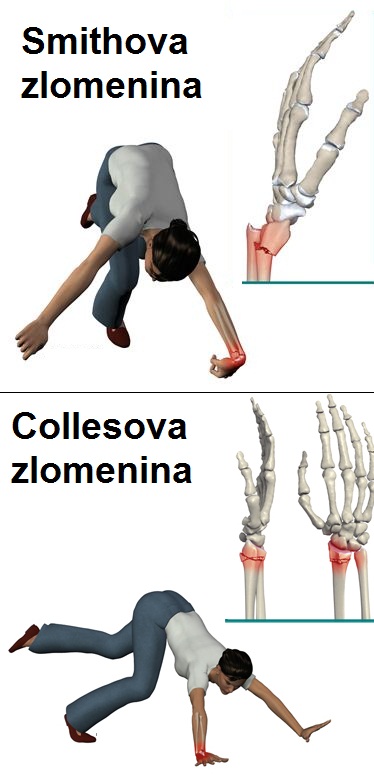 rozdil-smithova-collesova-zlomenina-zapesti-kosti-vretenni-priznaky-projevy-symptomy