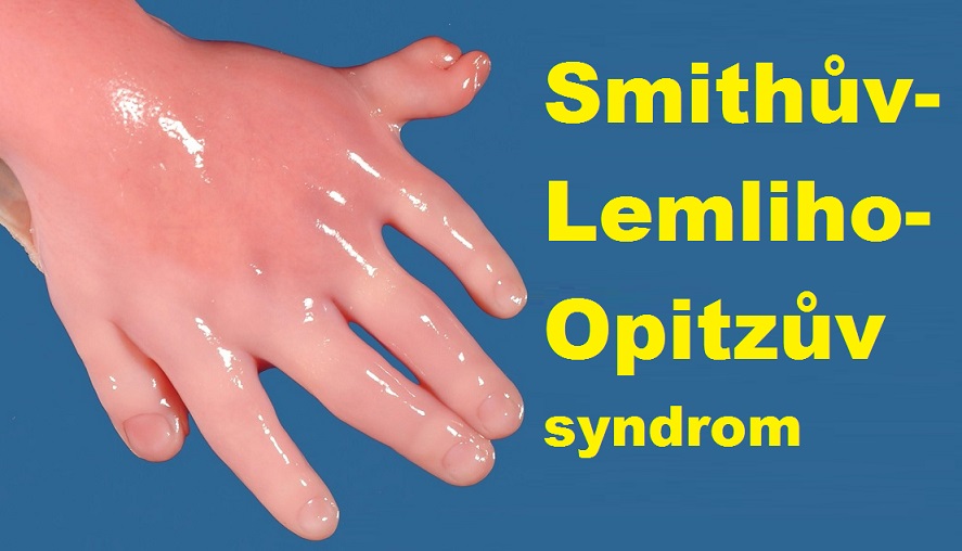 smithuv-lemliho-opitzuv-syndrom-priznaky-projevy-symptomy-0