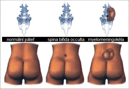 spina-bifida-rozstep-patere-priznaky-projevy-obrazek-fotografie-4