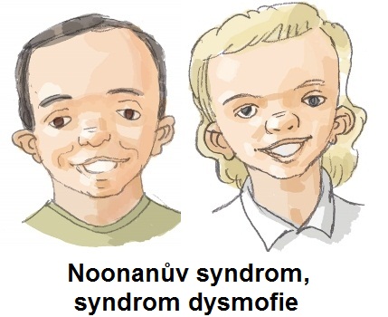syndrom-dysmorfie-noonanuv-syndrom-priznaky-projevy-symptomy