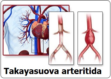 takayasuova-arteritida-priznaky-projevy-symptomy-55