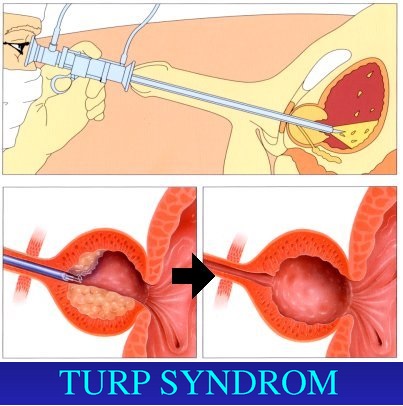 TUR-TURP-syndrom-priznaky-projevy-symptomy-obrazek-fotografie-2