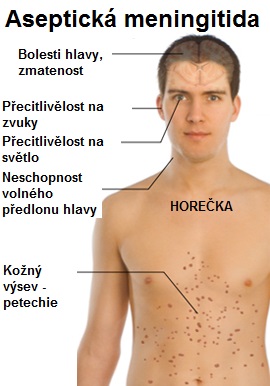 asepticka-meningitida-priznaky-projevy-symptomy