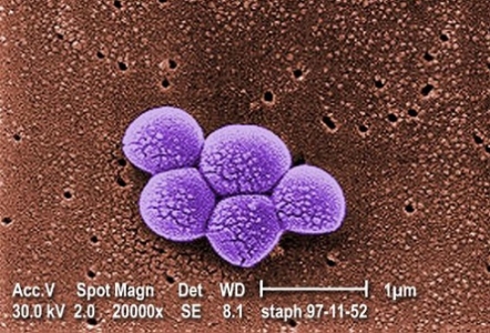 infekce-zlatym-stafylokokem-infekce-staphylococcus-aureus-priznaky-projevy-symptomy-12