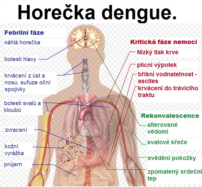 jak-se-projevuje-horecka-dengue-priznaky-projevy-symptomy-obrazek-fotografie-1