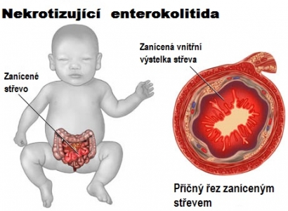 nekrotizujici-enterokolitida-priznaky-projevy-symptomy-obrazek-fotografie-3