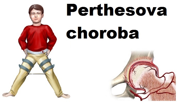 perthesova-choroba-morbus-perthes-priznaky-projevy-symptomy-obrazek-fotografie-4 copy