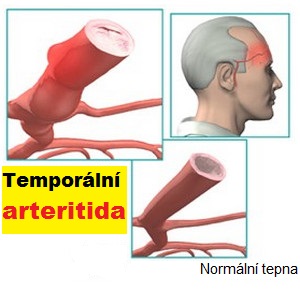 zanet-spankove-tepny-temporalni-arteritida-priznaky-projevy-symptomy-obrazek-fotografie-6