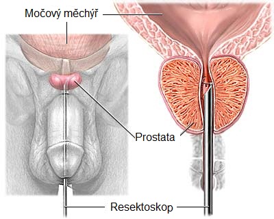 zvetsena-prostata-TUPR-frezovani-protaty-operace-provedeni-obrazek-fotografie